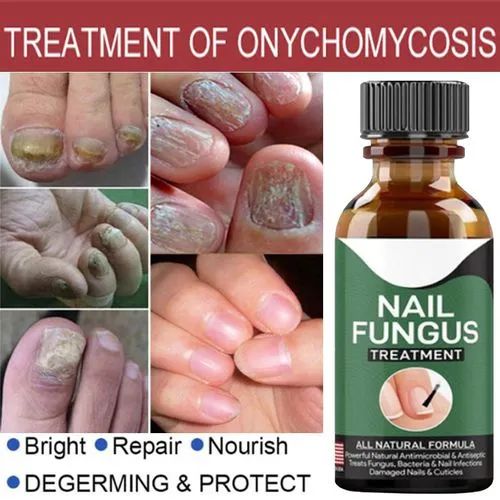 Fast Nail Fungal Treatment Repair Serum | Anti-Fungus | Nail Repair Essence - Mayari Super Store