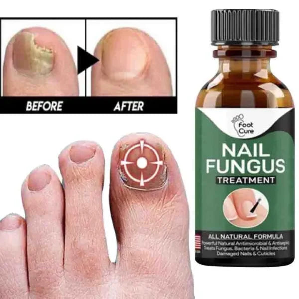 Fast Nail Fungal Treatment Repair Serum | Anti-Fungus | Nail Repair Essence - Mayari Super Store