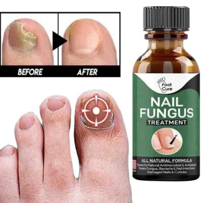 Fast Nail Fungal Treatment Repair Serum | Anti-Fungus | Nail Repair Essence - Mayari Super Store
